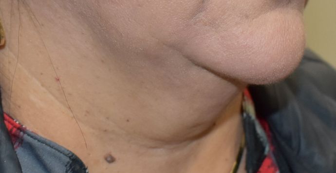 BodyTite Case 3 - Before