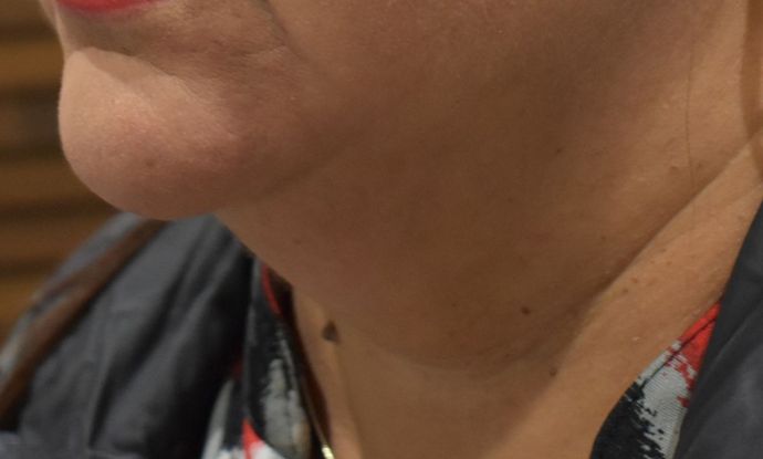 BodyTite: Case 3 - Before