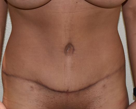 BodyTite Case 4 - After