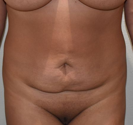 BodyTite Case 4 - Before