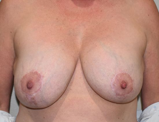 Breast Augmentation w/ Lift: Case 316 - After