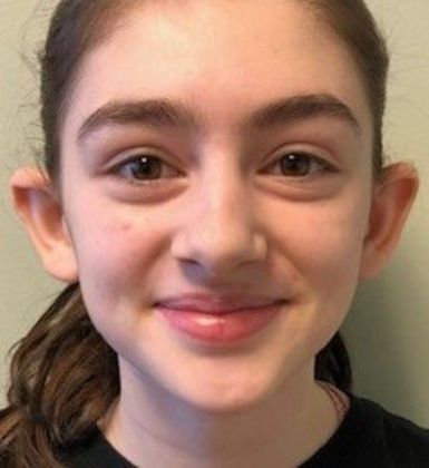 Otoplasty Case 7 Otoplasty Bristol, CT - Before