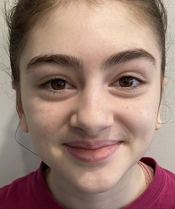 Otoplasty Case 7 Otoplasty Bristol, CT - After