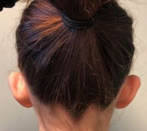 Otoplasty: Case 7 Otoplasty Bristol, CT - Before