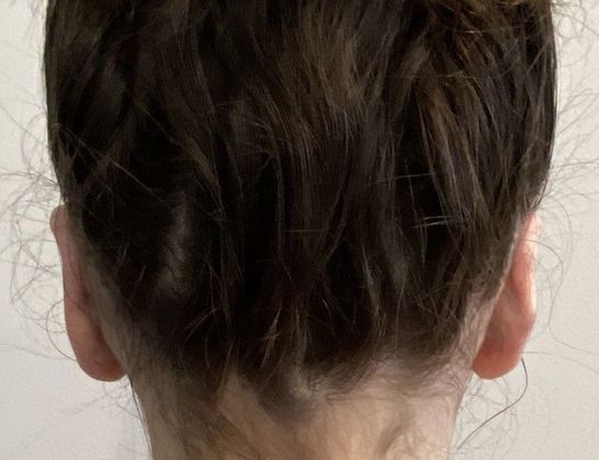 Otoplasty: Case 7 Otoplasty Bristol, CT - After