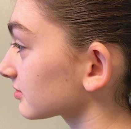 Otoplasty: Case 7 Otoplasty Bristol, CT - Before