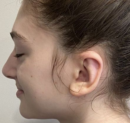 Otoplasty: Case 7 Otoplasty Bristol, CT - After