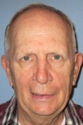 Direct Eyebrow Lift Case 1 - Before