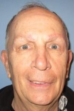 Direct Eyebrow Lift Case 1 - After