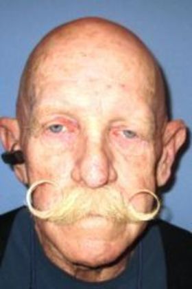 Direct Eyebrow Lift Wickenburg Resident Vision & Eyebrows Evened Out - Before