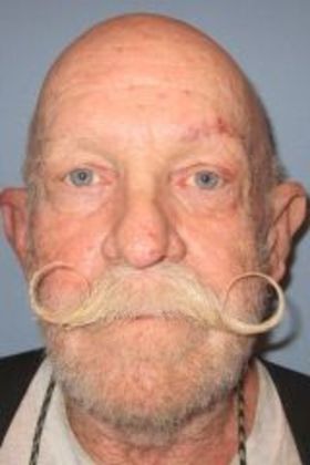 Direct Eyebrow Lift Wickenburg Resident Vision & Eyebrows Evened Out - After