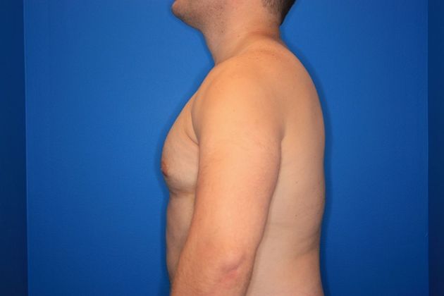 Liposuction: Case 1 - After