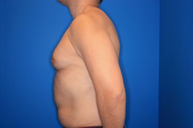 Liposuction: Case 1 - Before