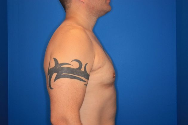 Liposuction: Case 1 - After