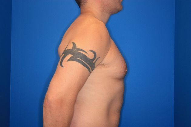 Liposuction: Case 1 - Before