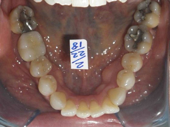 Invisalign: Case 7 - Before