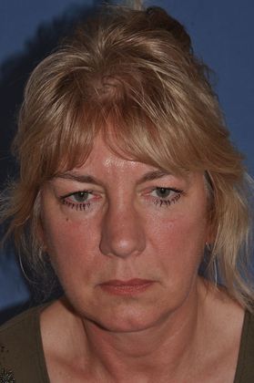 Eyelid Surgery Fat transposition lower lids, upper lids and facelift - Before