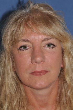 Eyelid Surgery Fat transposition lower lids, upper lids and facelift - After