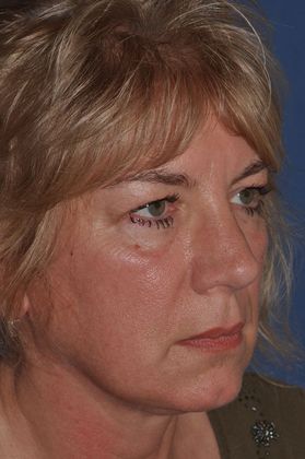 Eyelid Surgery: Fat transposition lower lids, upper lids and facelift - Before