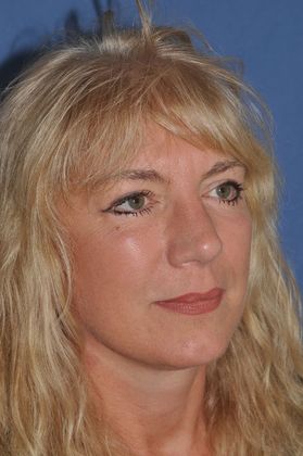 Eyelid Surgery: Fat transposition lower lids, upper lids and facelift - After