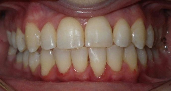 In-Office Zoom Whitening Case 1 - Before