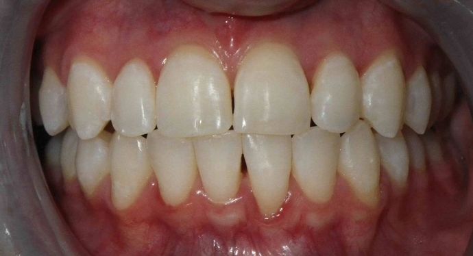In-Office Zoom Whitening Cases