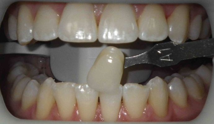 In-Office Zoom Whitening Case 2 - Before