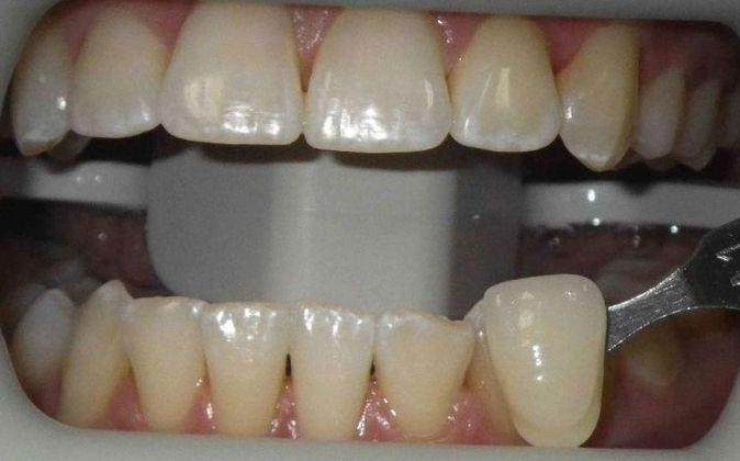 In-Office Zoom Whitening: Case 2 - Before