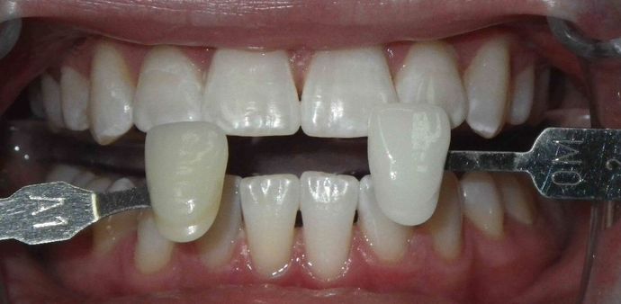 In-Office Zoom Whitening Case 2 - After