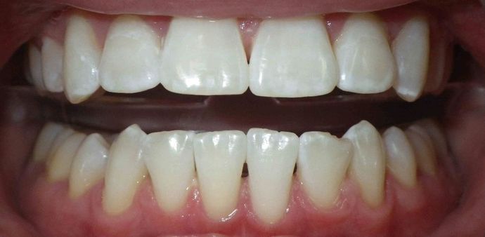 In-Office Zoom Whitening: Case 2 - After