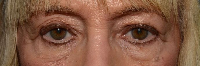 Eyelid Surgery: Case 7 - Indianapolis Lower Eyelid Lift - Before