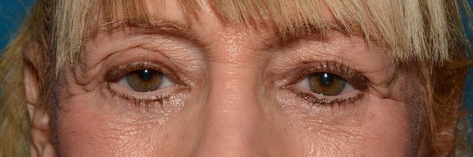 Eyelid Surgery: Case 7 - Indianapolis Lower Eyelid Lift - After