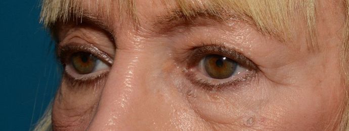 Eyelid Surgery: Case 7 - Indianapolis Lower Eyelid Lift - Before