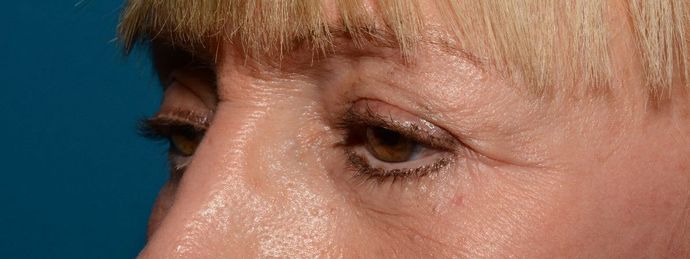 Eyelid Surgery: Case 7 - Indianapolis Lower Eyelid Lift - After