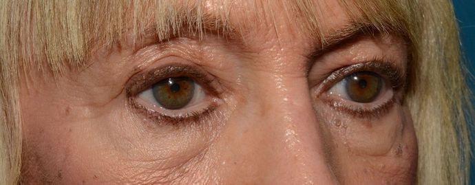 Eyelid Surgery: Case 7 - Indianapolis Lower Eyelid Lift - Before