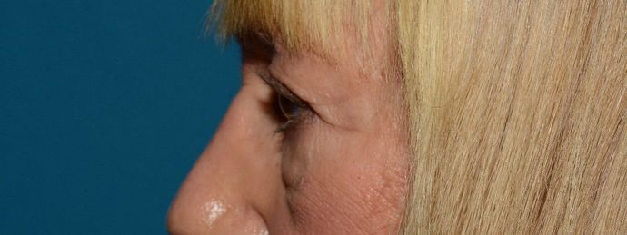 Eyelid Surgery: Case 7 - Indianapolis Lower Eyelid Lift - Before