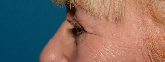 Eyelid Surgery: Case 7 - Indianapolis Lower Eyelid Lift - After