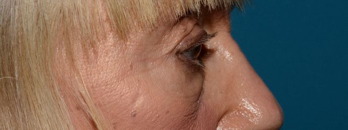 Eyelid Surgery: Case 7 - Indianapolis Lower Eyelid Lift - Before