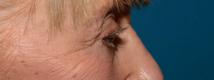 Eyelid Surgery: Case 7 - Indianapolis Lower Eyelid Lift - After