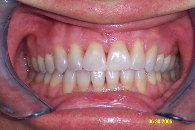 Invisalign: Case 9 - After