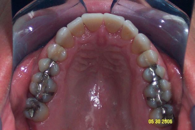 Invisalign: Case 9 - After
