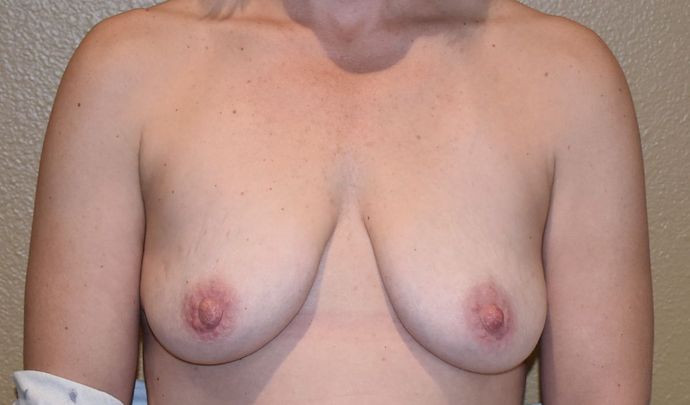 Breast Augmentation w/ Lift: Case 317 - Before