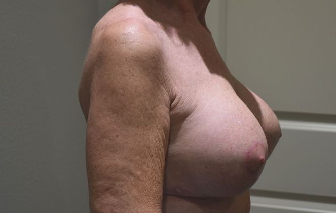 Breast Augmentation w/ Lift: Case 318 - After