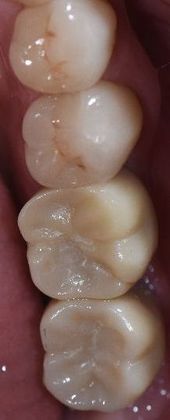 Dental Implants Case 2 - Refugio, TX - After
