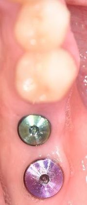 Dental Implants Case 2 - Refugio, TX - Before