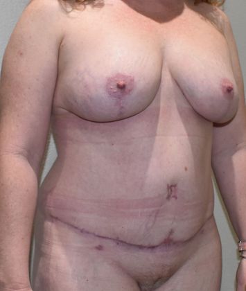 Mommy Makeover: Case 158 - After