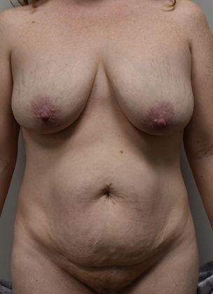 Mommy Makeover Case 158 - Before