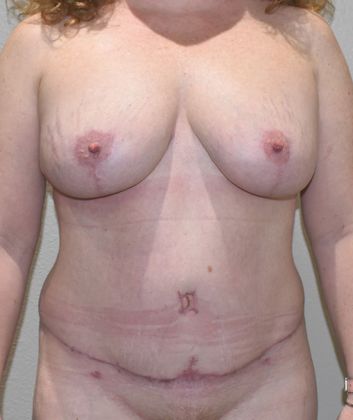 Mommy Makeover Case 158 - After