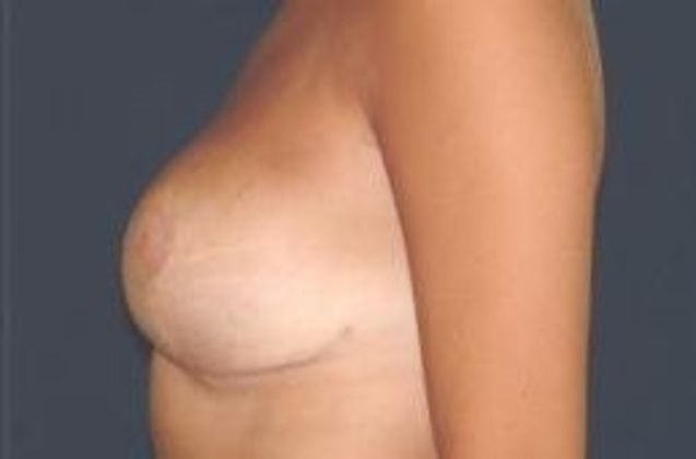 Breast Reduction Case 1 - After