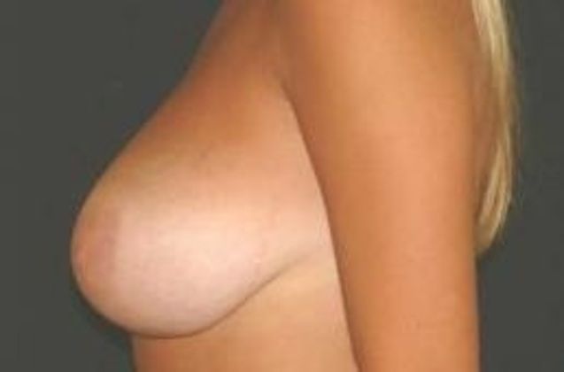 Breast Reduction Case 1 - Before